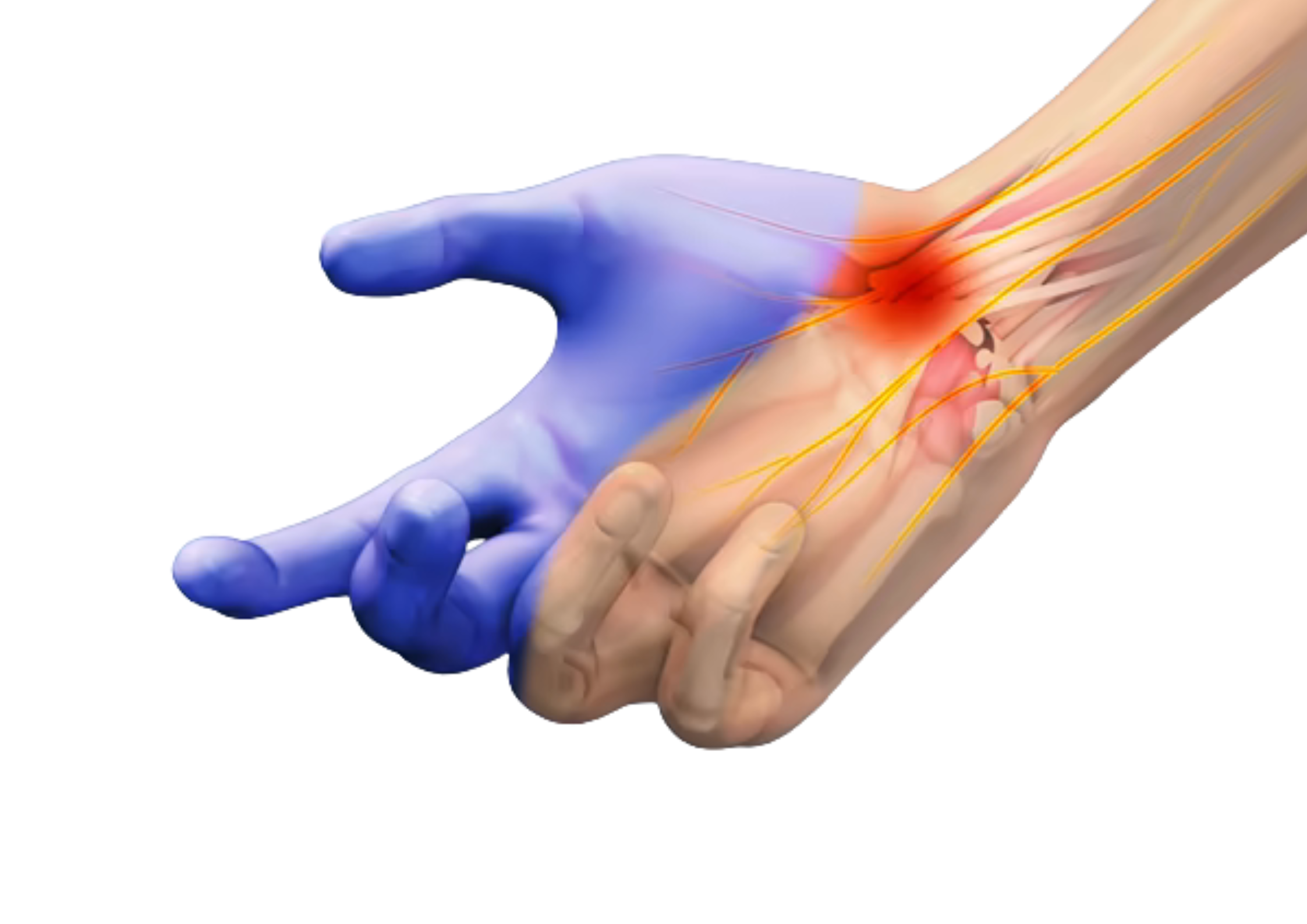 Neuropatías: Síndrome del Túnel Carpiano, lumbociática, parestesias…