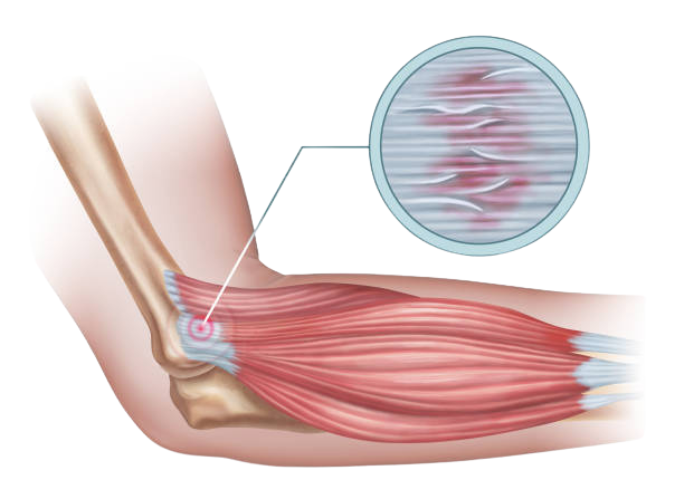 Tendinopatías: Rotuliana, Aquílea, Epicondilitis, Fascitis plantar…